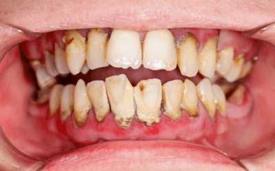 Why do low carbohydrate diets accelerate aggressive tartar buildup beneath the gumline?