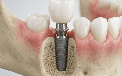 Can You Get Dental Implants If You Have Osteoporosis?