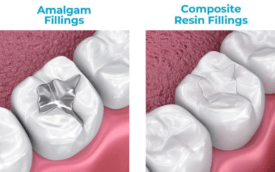 Silver vs. Composite Fillings: Which Lasts Longer?